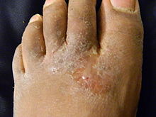 Feet fungal infection